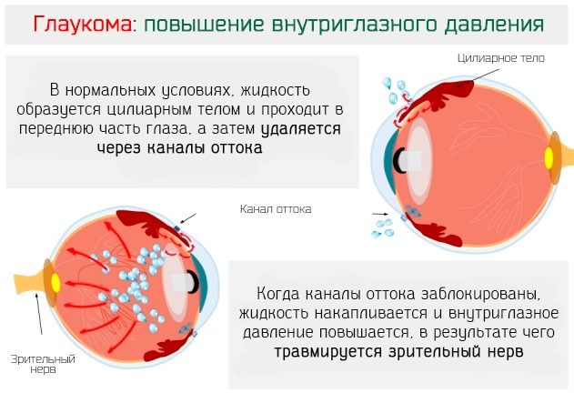 Кленил УДВ (Clenil UDV) для ингаляций. Инструкция по применению