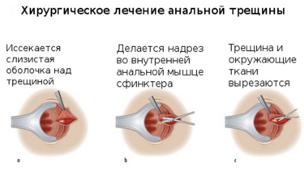 Лечение анальной трещины в домашних условиях. Мази, свечи, народные средства