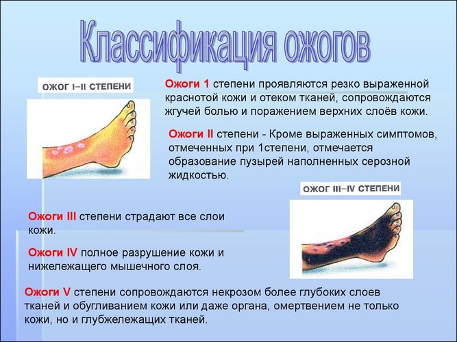 Лечение ожоговых ран, волдырей, солнечный, термический, химический, кипятком. Первая помощь, препараты, процедуры, народные средства