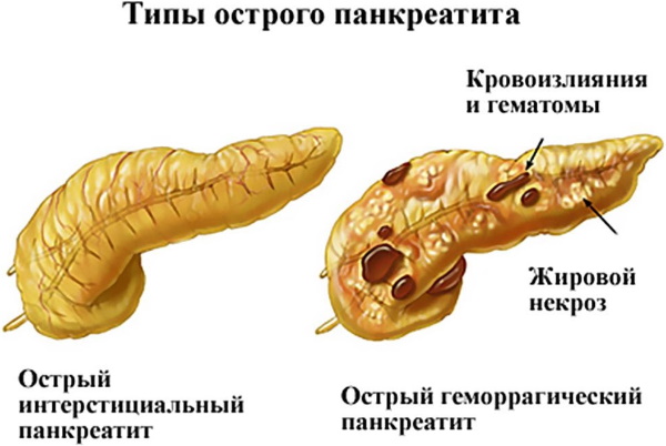 Воспаление желчных протоков. Симптомы и лечение