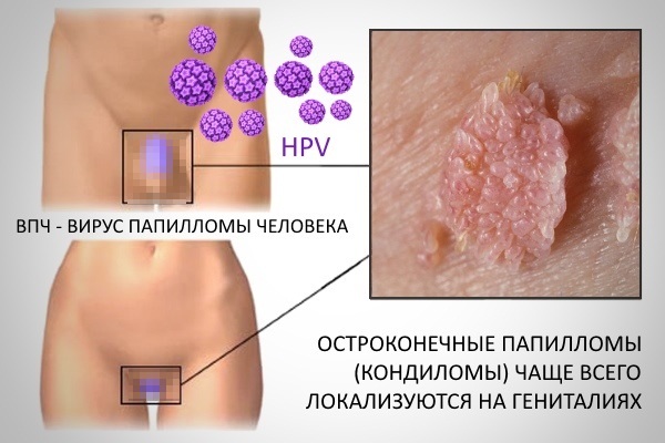 Лечение папиллом на шее, теле, лице, под мышками в домашних условиях. Препараты, чистотел, народные средства, мази