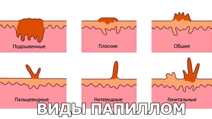 Лечение папиллом на шее, теле, лице, под мышками в домашних условиях. Препараты, чистотел, народные средства, мази