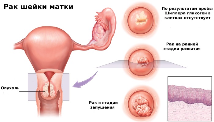 Лечение папиллом на шее, теле, лице, под мышками в домашних условиях. Препараты, чистотел, народные средства, мази