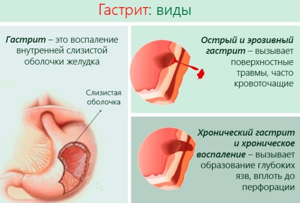 Соленая слюна во рту. Причины у женщин, мужчин, новорожденного, лечение