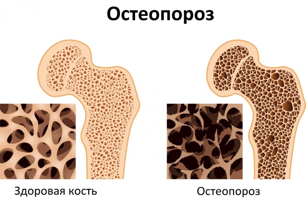 Лечение при климаксе. Лекарства от приливов, гомеопатические препараты, народные средства, как принимать