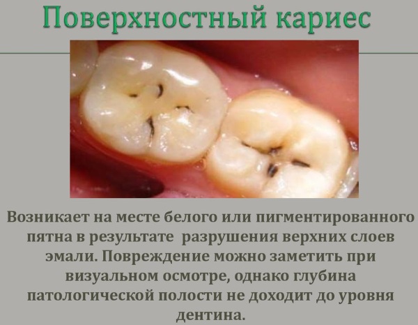 Лекарства от фарингита у взрослых. Лучшие таблетки, капли через нос, спрей, антибиотики