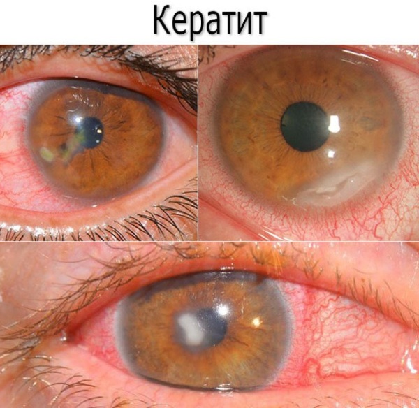 Рибофлавин (Riboflavin) в таблетках. Цена, инструкция по применению, отзывы