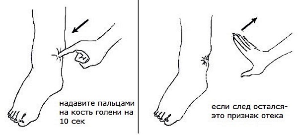 Лечение лимфостаза нижних конечностей в домашних условиях народными средствами, медикаментозно, упражнениями, массажем, диетой