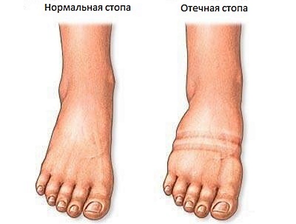Лечение лимфостаза нижних конечностей в домашних условиях народными средствами, медикаментозно, упражнениями, массажем, диетой