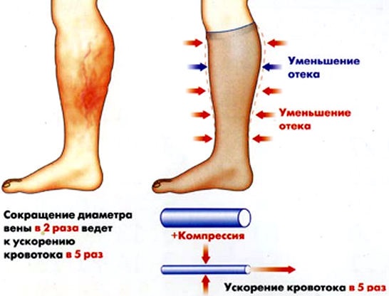 Лечение лимфостаза нижних конечностей в домашних условиях народными средствами, медикаментозно, упражнениями, массажем, диетой