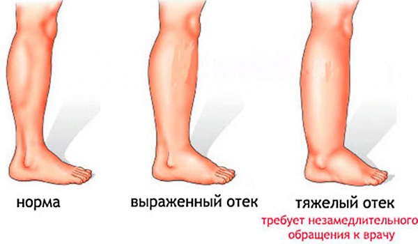 Лечение лимфостаза нижних конечностей в домашних условиях народными средствами, медикаментозно, упражнениями, массажем, диетой