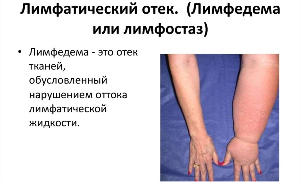 Лечение лимфостаза нижних конечностей в домашних условиях народными средствами, медикаментозно, упражнениями, массажем, диетой