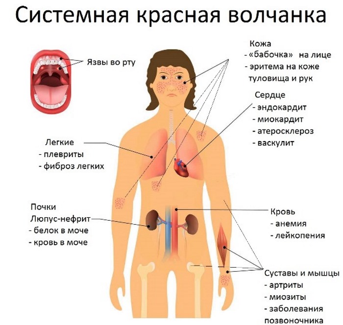 Лимфоциты повышены у ребенка в крови, нейрофилы понижены. О чем это говорит, норма по возрасту, таблица. Причины, симптомы