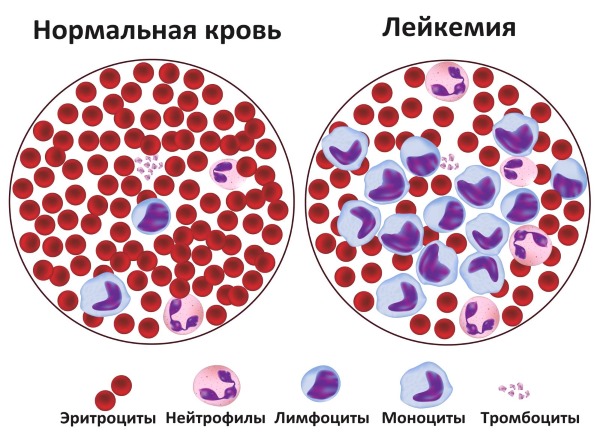 Лимфоциты повышены у ребенка в крови, нейрофилы понижены. О чем это говорит, норма по возрасту, таблица. Причины, симптомы