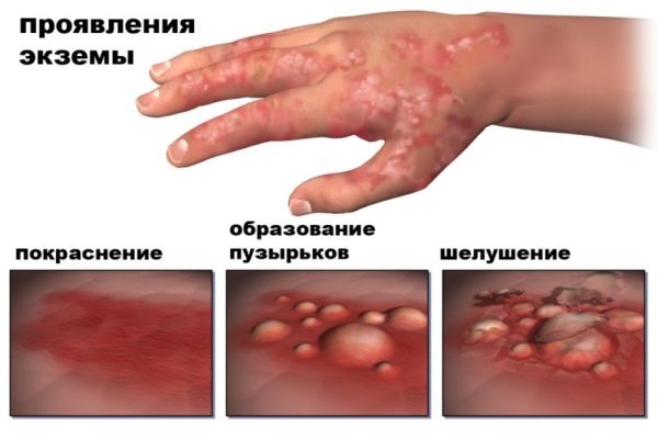 Лишай у ребенка. Фото признаков на теле, лице, голове, лечение народными средствами, медикаментозно