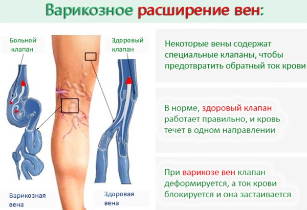 Эндовазальная лазерная коагуляция вен нижних конечностей. Осложнения, противопоказания