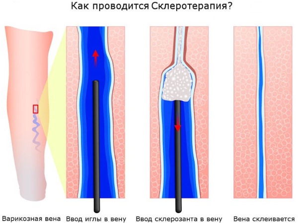 Лопаются капилляры на ногах, появляются синяки, пятна. Что делать, причины и лечение