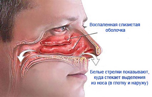 Эффективные средства от насморка взрослым: народные, аптечные препараты. Как вылечить насморк в домашних условиях