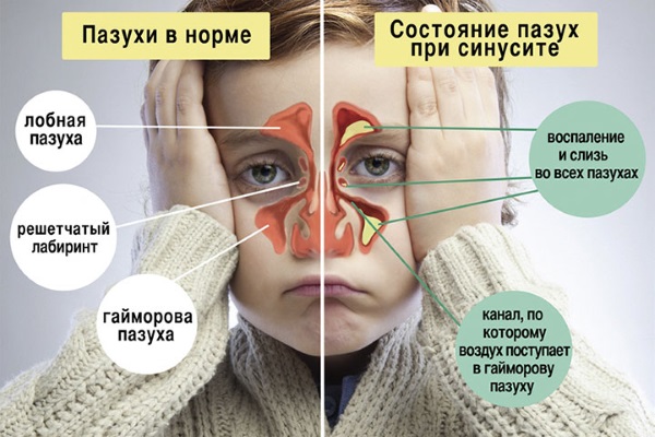 Эффективные средства от насморка взрослым: народные, аптечные препараты. Как вылечить насморк в домашних условиях