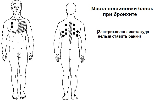 Массаж для отхождения мокроты у ребенка, взрослых, грудничков. Как делать при кашле, пневмонии, бронхите
