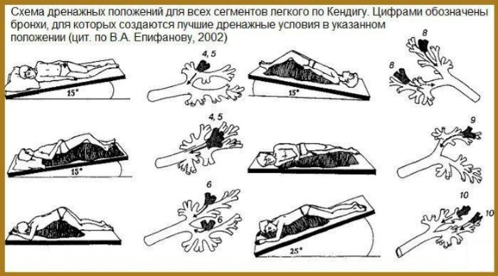 Массаж для отхождения мокроты у ребенка, взрослых, грудничков. Как делать при кашле, пневмонии, бронхите