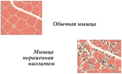 Вольтарен (Voltaren) или Диклофенак (Diclofenac). Что лучше, эффективнее: гель, мазь, уколы, свечи