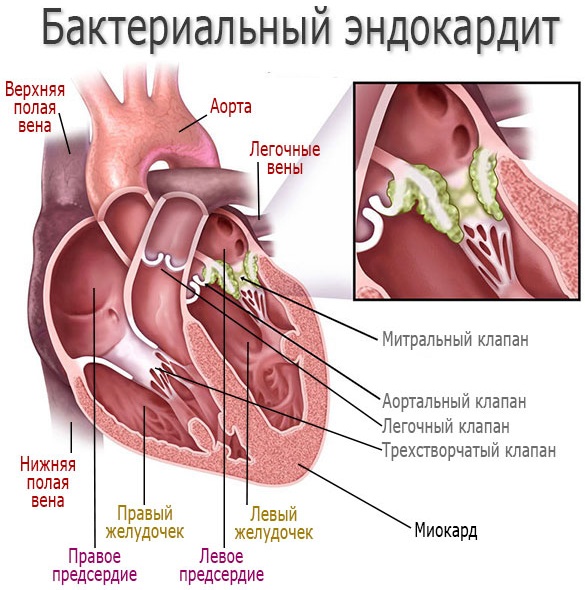 Эндокардит у взрослых. Симптомы, диагностика и лечение