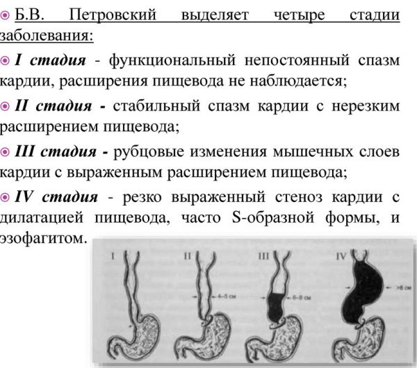 Недостаточность кардии и привратника желудка. Что это