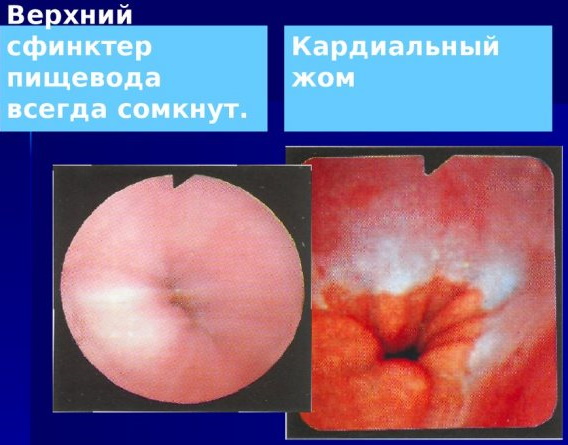 Недостаточность кардии и привратника желудка. Что это