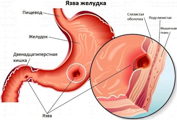 Непереносимость лактозы. Симптомы у взрослых, детей. Признаки, анализы. Лечение, чем заменить молочные продукты