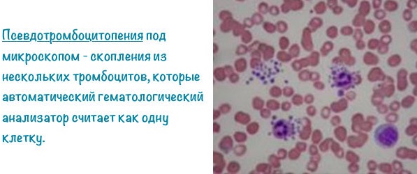 Низкий уровень тромбоцитов в крови. Причины у женщин, мужчин, детей. Чем грозит, что делать