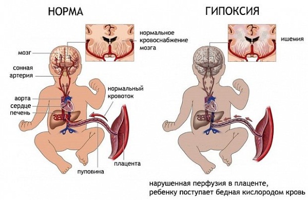 Норма билирубина у новорожденных, таблица предела в крови, анализ, причины, последствия повышенного, как снизить, лечение
