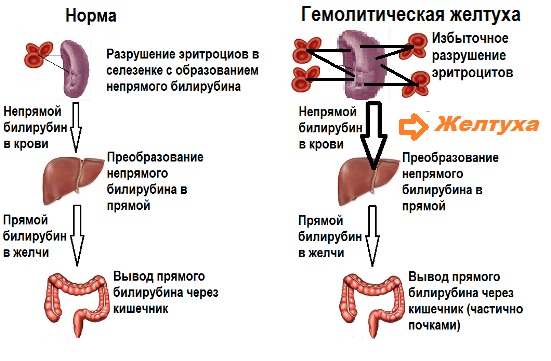 Норма билирубина у новорожденных, таблица предела в крови, анализ, причины, последствия повышенного, как снизить, лечение