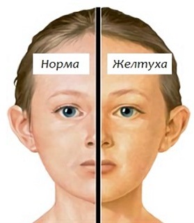 Норма билирубина у новорожденных, таблица предела в крови, анализ, причины, последствия повышенного, как снизить, лечение