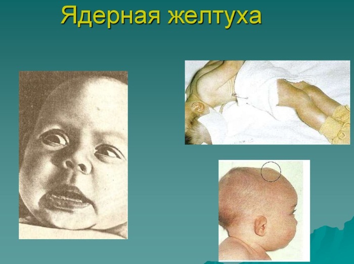 Норма билирубина у новорожденных, таблица предела в крови, анализ, причины, последствия повышенного, как снизить, лечение