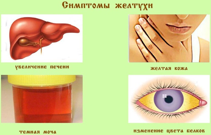 Признаки желтухи у взрослых, фото, как передается, лечение