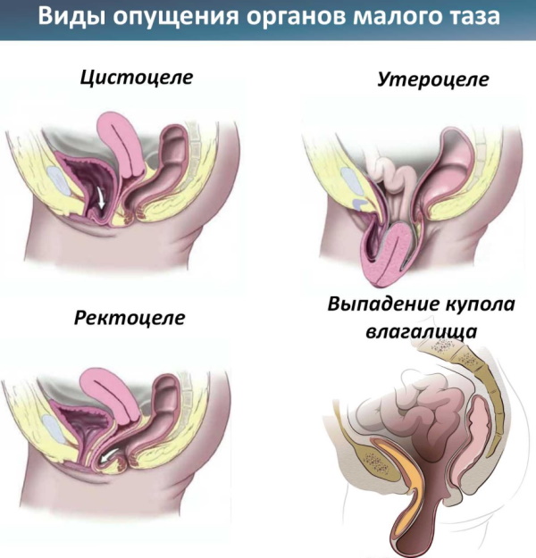 Опущение задней стенки матки. Симптомы и лечение