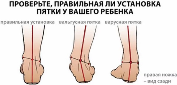 ОртоФикс от вальгуса. Инструкция по применению, развод или правда, цена, отзывы