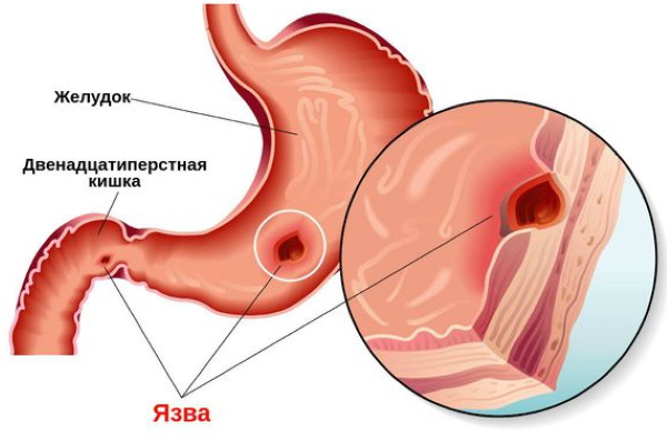 Оциллококцинум при беременности 1-2-3 триместр. Инструкция по применению, отзывы