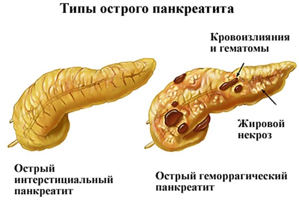 Панкреатит. Симптомы и лечение у взрослых. Народные средства, препараты, диета. Что можно, нельзя