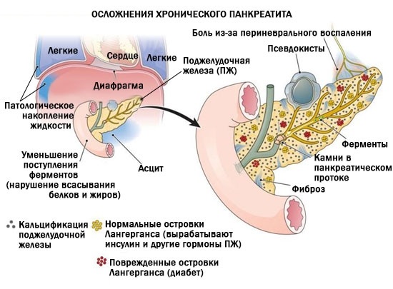 Панкреатит. Симптомы и лечение у взрослых. Народные средства, препараты, диета. Что можно, нельзя