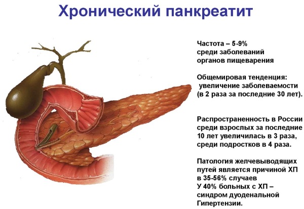 Панкреатит. Симптомы и лечение у взрослых. Народные средства, препараты, диета. Что можно, нельзя