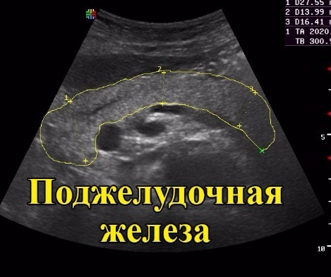 Панкреатит. Симптомы и лечение у взрослых. Народные средства, препараты, диета. Что можно, нельзя