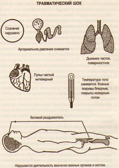 ПМП при травматическом шоке. Презентация, алгоритм, причины