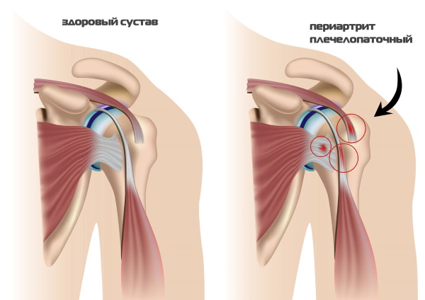 Полиартрит плечевого сустава. Симптомы и лечение, народные средства, гимнастика, лекарства