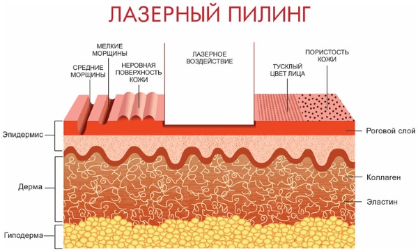 Постакне. Как избавиться, лечение, аптечные средства, кремы, коррекция рубцов, пилинг, лазерная шлифовка