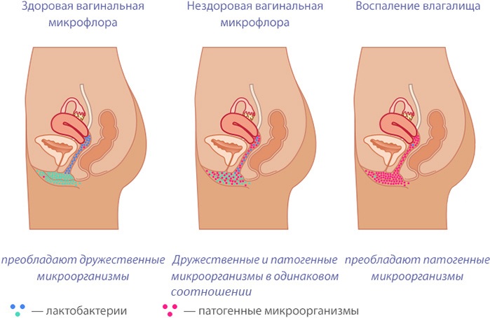 Посткоитальный цистит у женщин, мужчин. Что это такое, симптомы, лечение