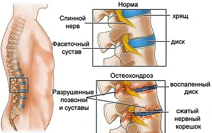 Бандаж для пупочной грыжи женский, мужской, детский. Как выбрать, носить, цены
