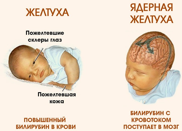 Признаки желтухи у взрослых, фото, как передается, лечение