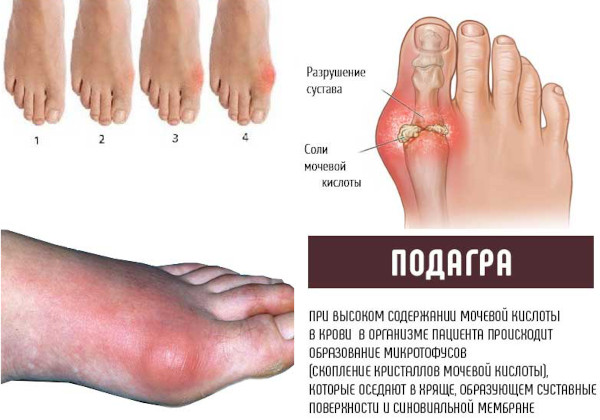 Пробенецид. Инструкция по применению, цена, отзывы